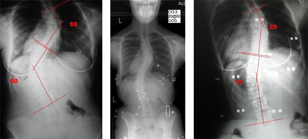 (L) Pre-Treatment; (C) In-Brace; (R) In the Scoliosis Traction Chair