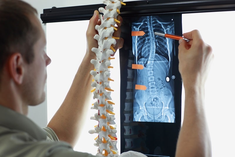 The 3-Dimensional Nature of a Scoliosis Curvature.