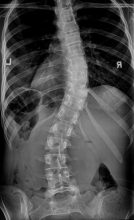 Scoliosis X-Ray