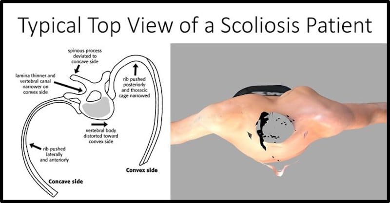 Top view of diagram of scoliosis patient