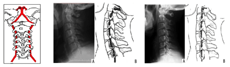 picture of cervical spine with neck arteries showing, x-ray of normal spinal curve, x-ray of loss of spinal curve