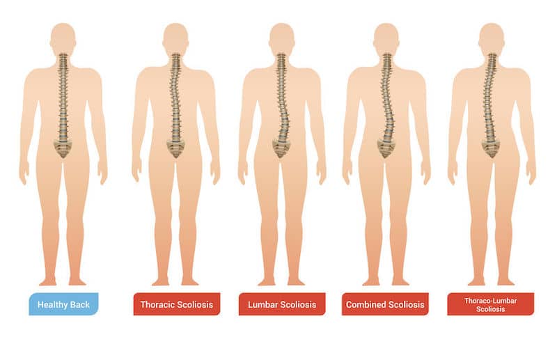 straight spine, healthy back; curved upper spine, thoracic scoliosis; curved lower spine, lumbar scoliosis; curved upper and lower spine, combined scoliosis; curved full spine, thoracolumbar scoliosis