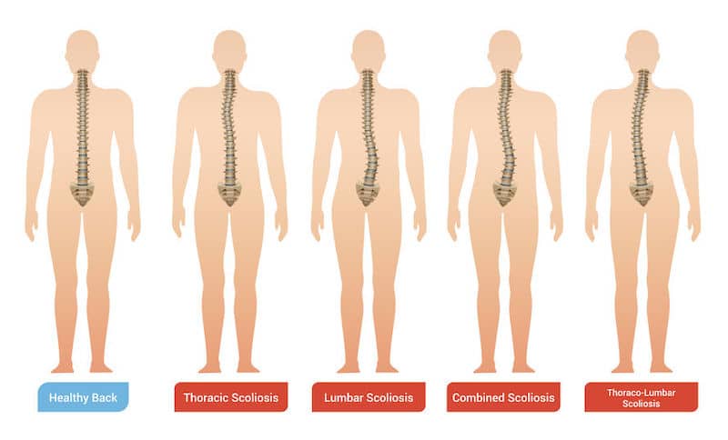 SSS thoraco-lumbar scoliosis model