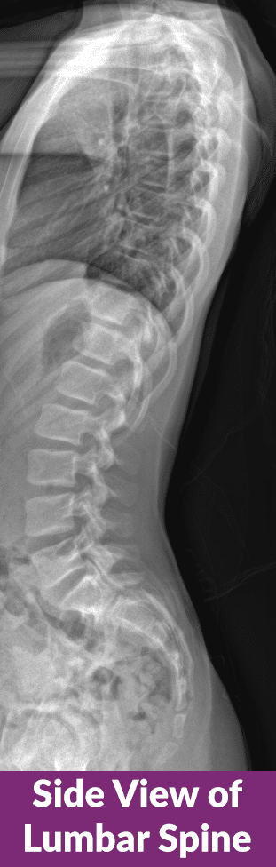 side view of lumbar spine