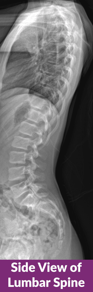 X ray dorso lumbar spine A/P and lateral views showing Kypho