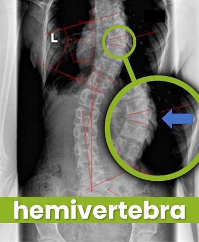 hemivertebra