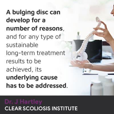 A bulging disc can develop