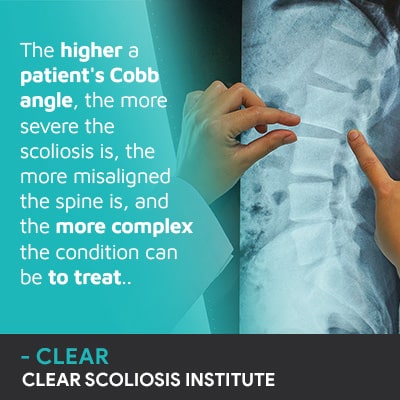 The higher a patient's Cobb angle