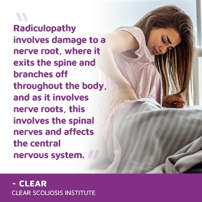 A visual representation of the quote from the text starting with “Radiculopathy involves damage to a"
