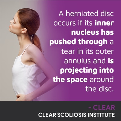 A visual representation of the quote from the text starting with “A Herniated Disc Occurs"