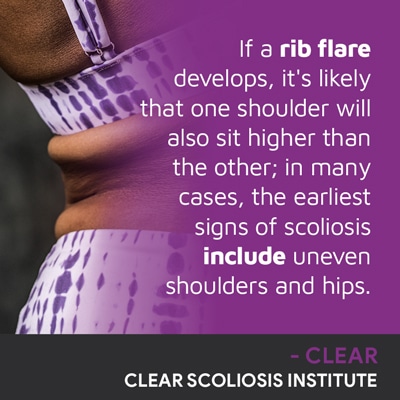 A visual representation of the quote from the text starting with “If a rib flare develops"