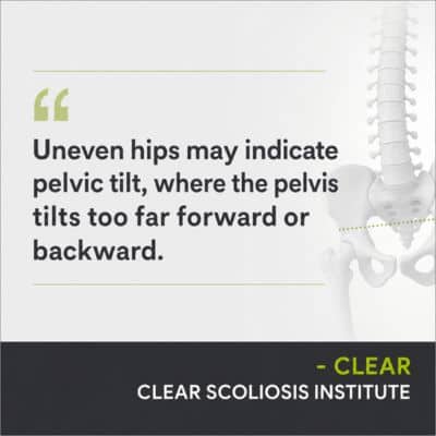A visual representation of the quote from the text starting with “If the hips are uneven, pelvic tilt"